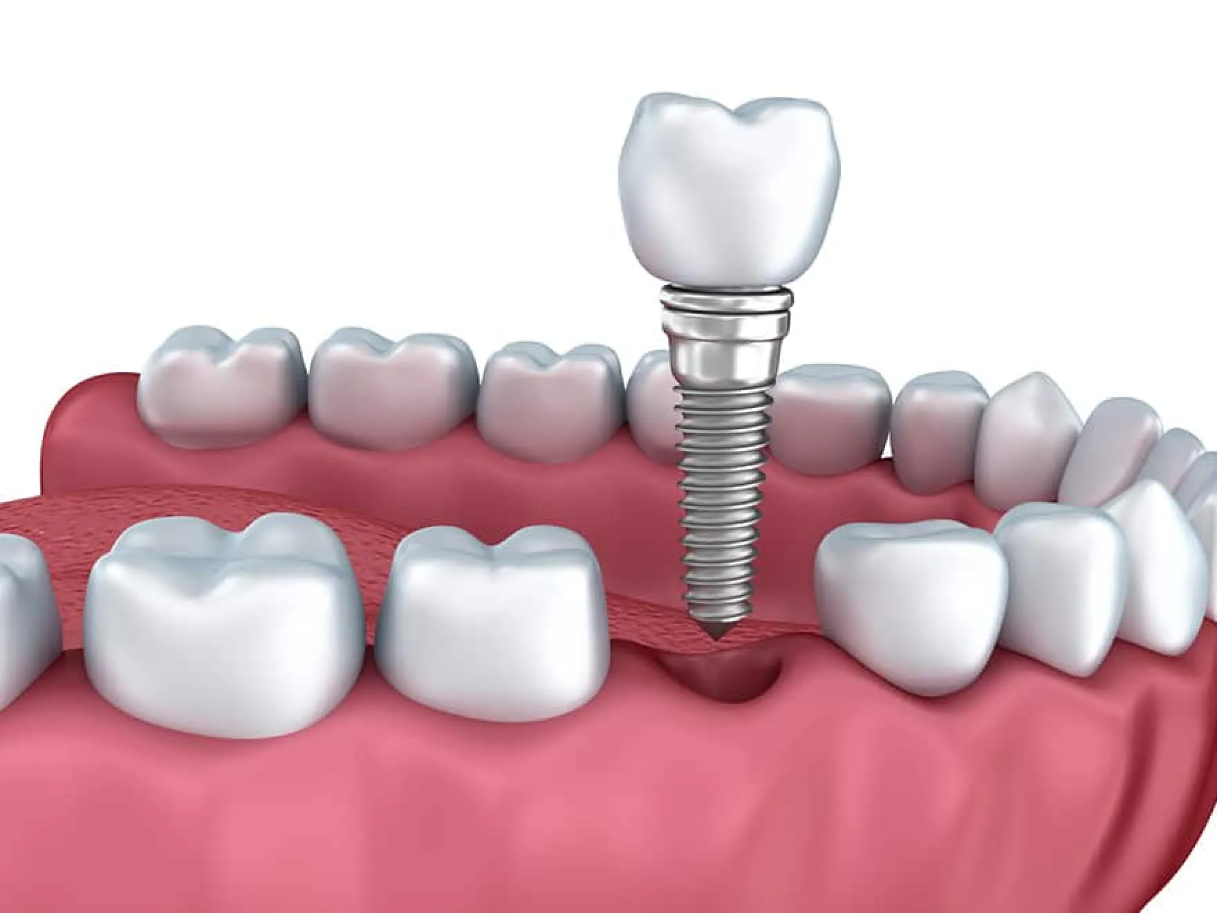 Dental implants in Mt. Airy, MD